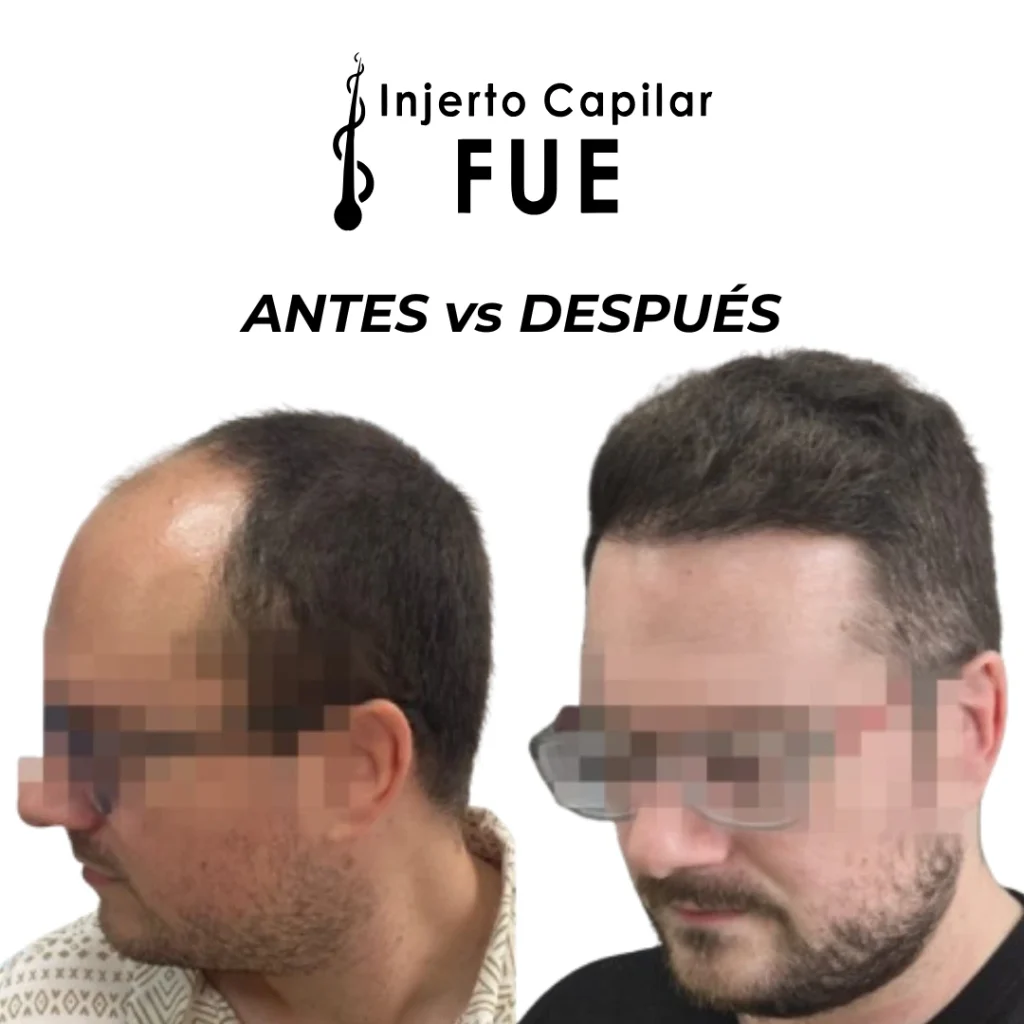 resultados de injerto capilar en Sevilla