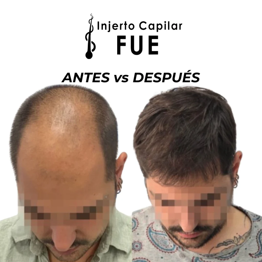 resultados de injerto capilar en Sevilla