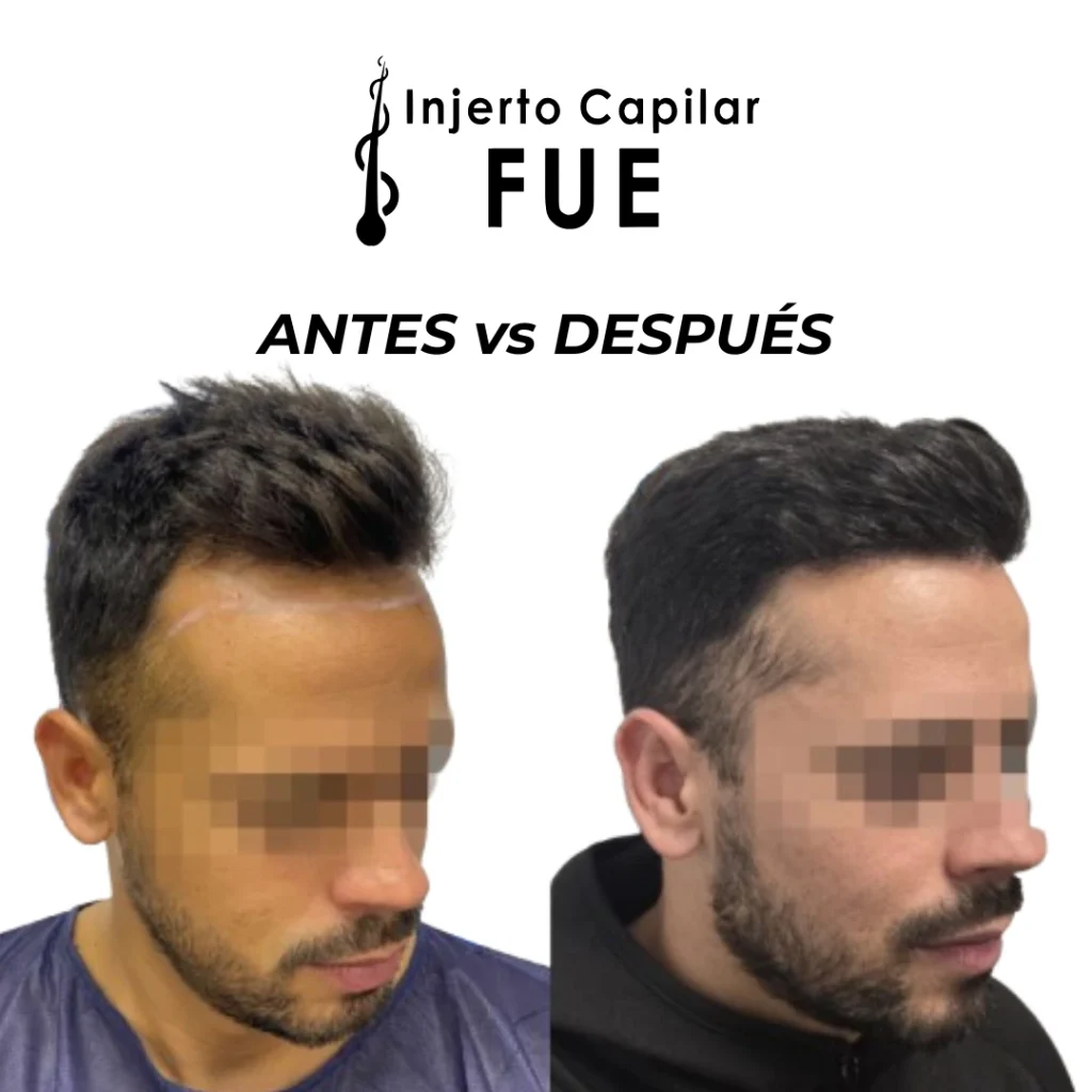 precio de injerto capilar en Sevilla