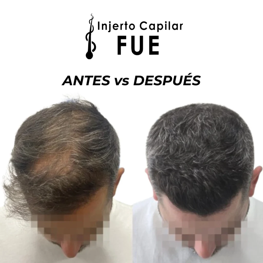 precio de injerto capilar en Sevilla