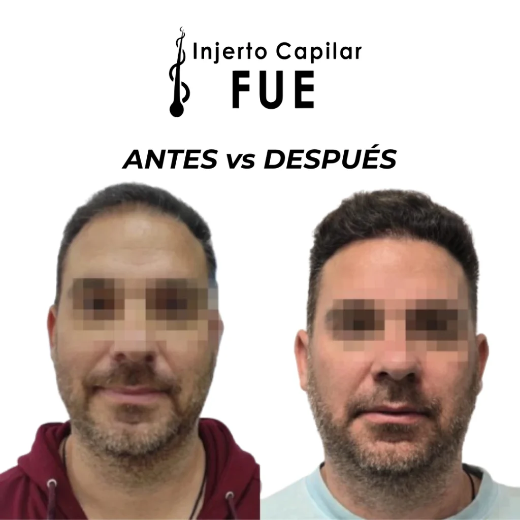clínicas capilares en Sevilla