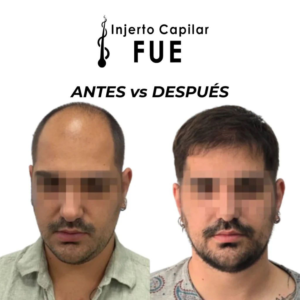 injerto capilar en Sevilla