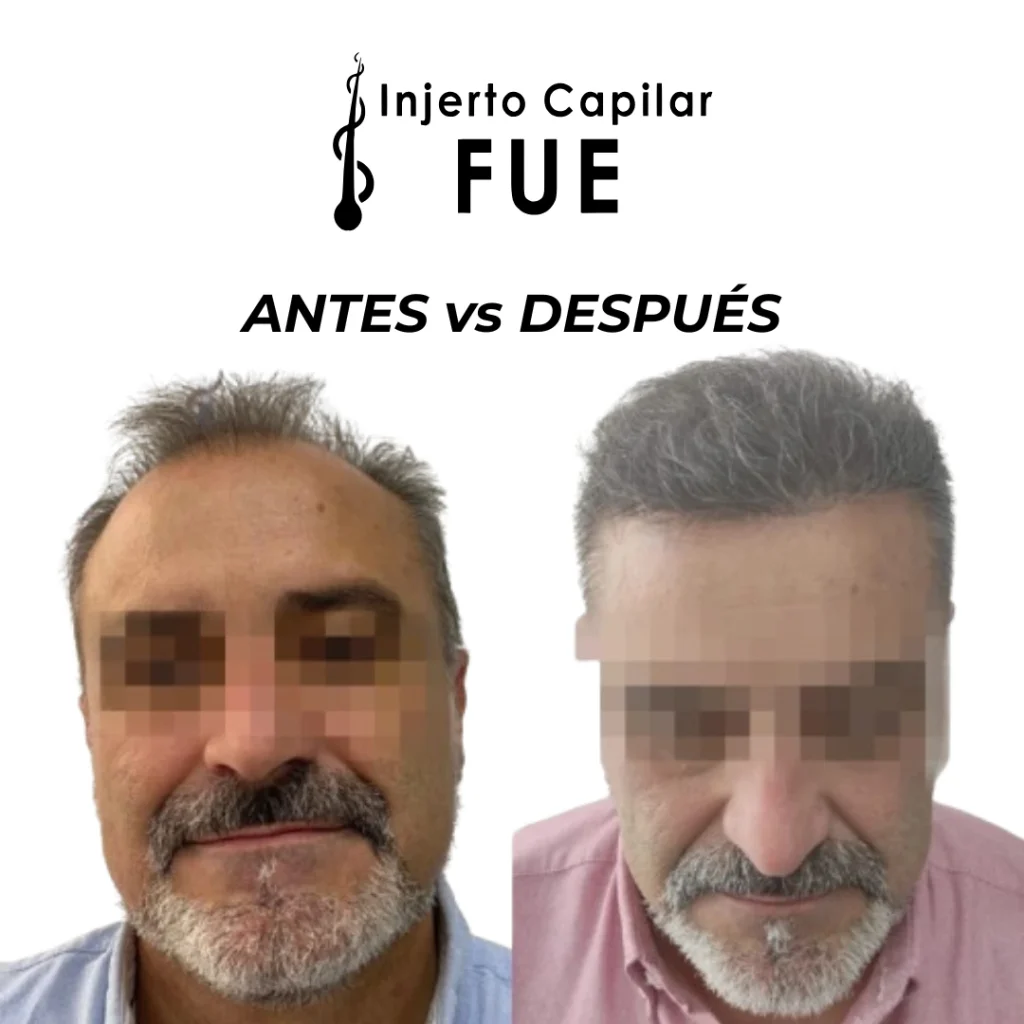 injerto capilar en Sevilla