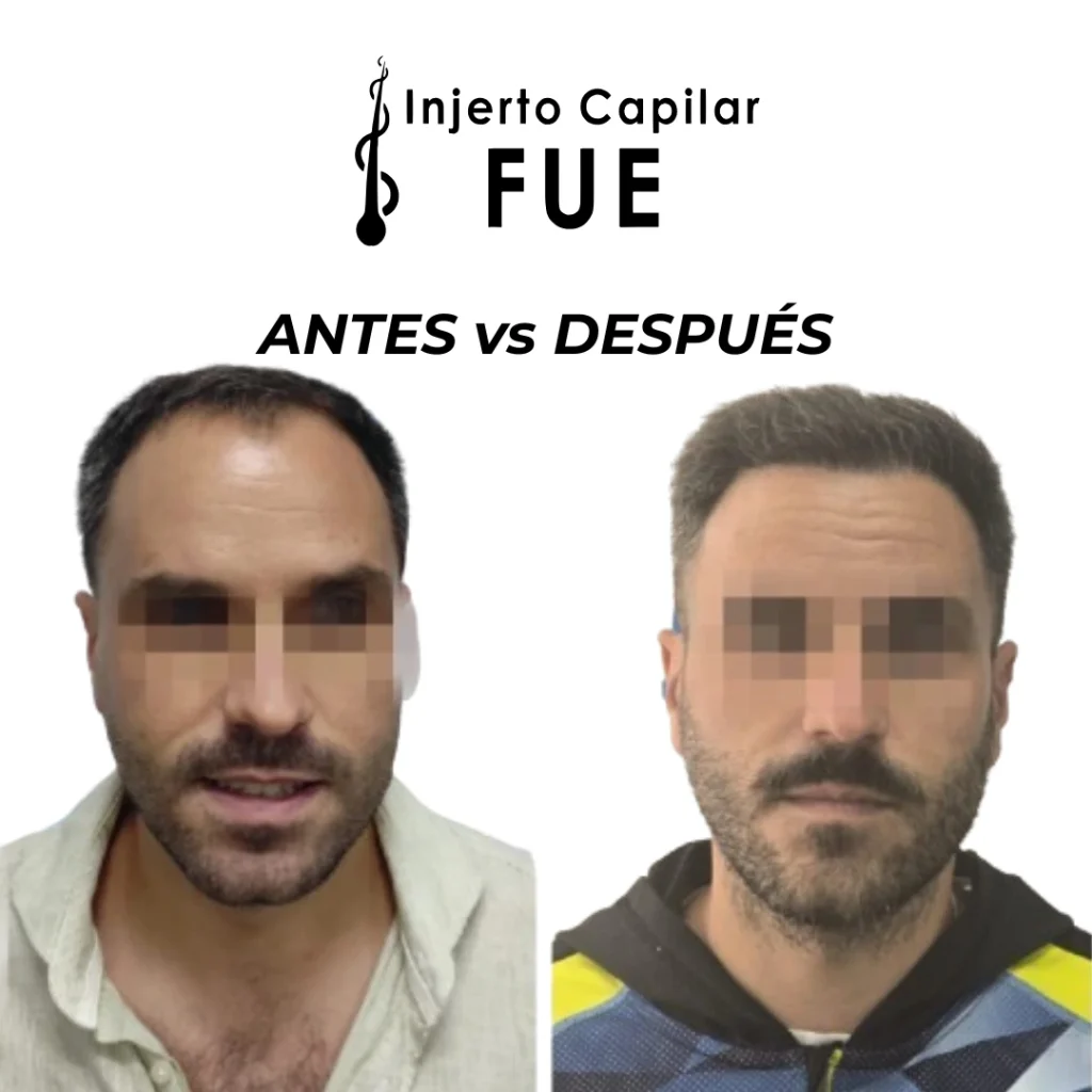 injerto capilar en Sevilla