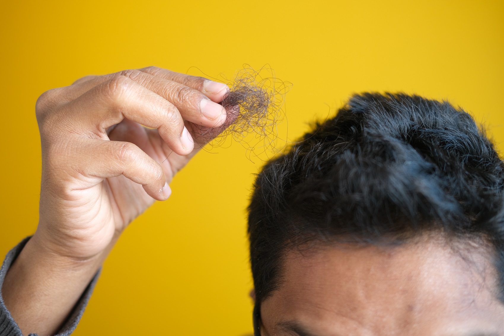 pérdida de cabello en hombre antes de acudir a clínica capilar en Sevilla